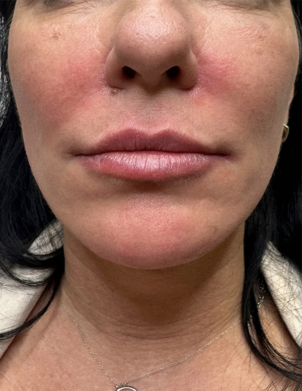 After Image: PDO Thread Lift and Facial Balancing - front
