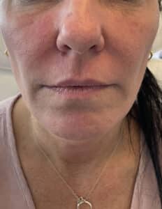 PDO Thread Lift and Facial Balancing