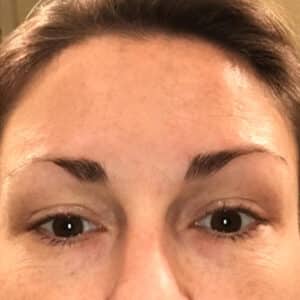 Botox and VI Chemical Peel