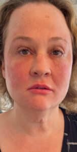 PDO Thread Lift and PRF Injections