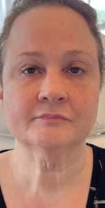 PDO Thread Lift and PRF Injections