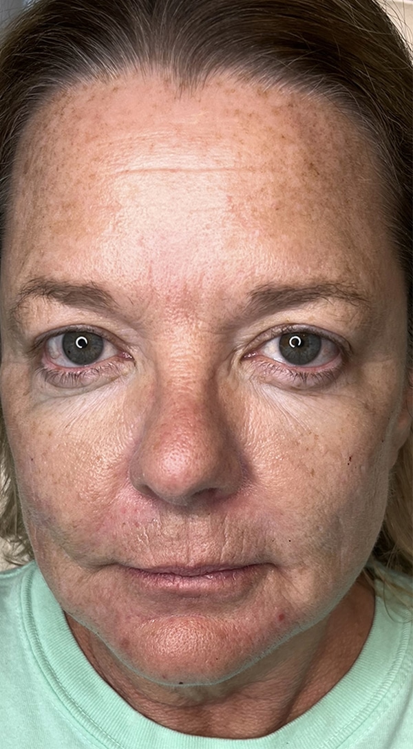 After Image: Vampire Facelift - front