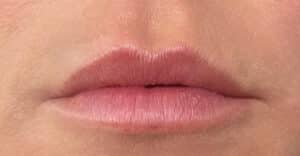 Lip Filler