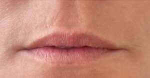 Lip Filler